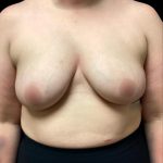 Breast Augmentation Before & After Patient #5850