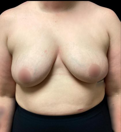 Breast Augmentation Before & After Patient #5850
