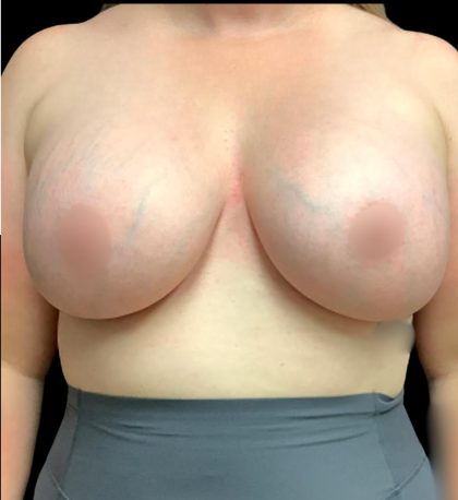 Breast Augmentation Before & After Patient #5850