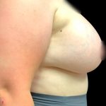 Breast Augmentation Before & After Patient #5850
