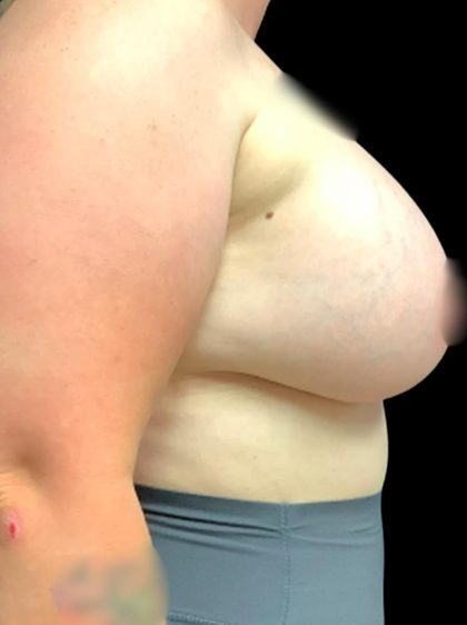 Breast Augmentation Before & After Patient #5850