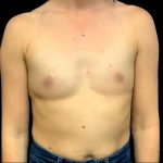 Breast Augmentation Before & After Patient #6003