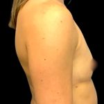 Breast Augmentation Before & After Patient #6003