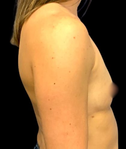 Breast Augmentation Before & After Patient #6003