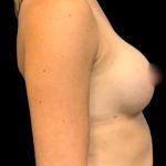 Breast Augmentation Before & After Patient #6003