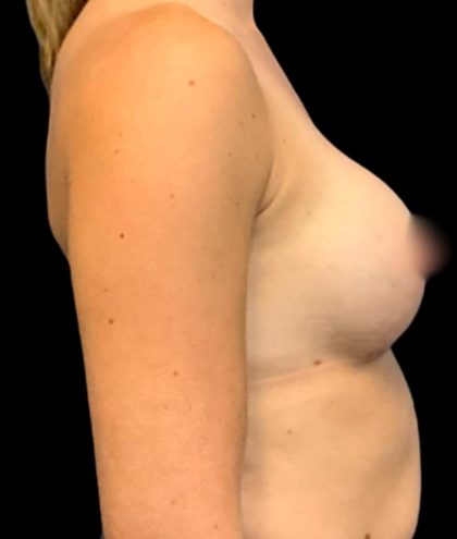 Breast Augmentation Before & After Patient #6003
