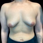Breast Augmentation Before & After Patient #6089