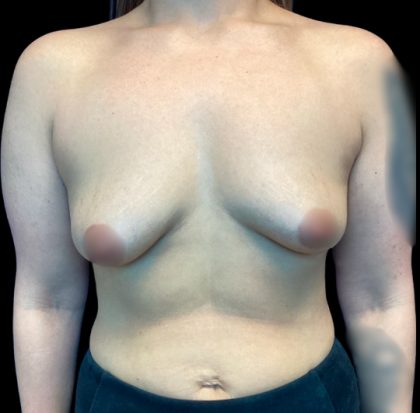 Breast Augmentation Before & After Patient #6089