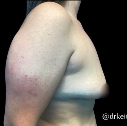 Breast Augmentation Before & After Patient #6089
