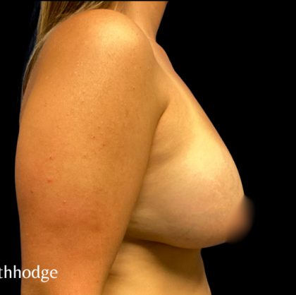 Breast Augmentation Before & After Patient #6089