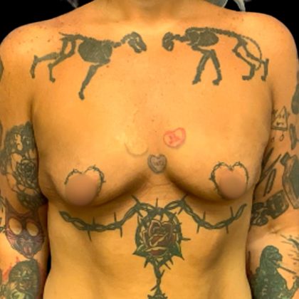 Breast Augmentation Before & After Patient #6002