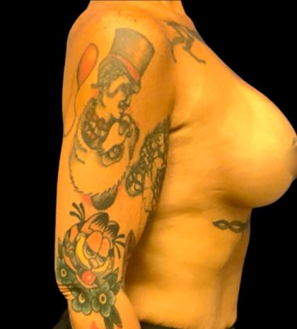 Breast Augmentation Before & After Patient #6002