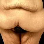 Liposuction Before & After Patient #6001
