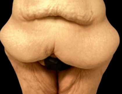 Liposuction Before & After Patient #6001