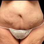 Liposuction Before & After Patient #6001