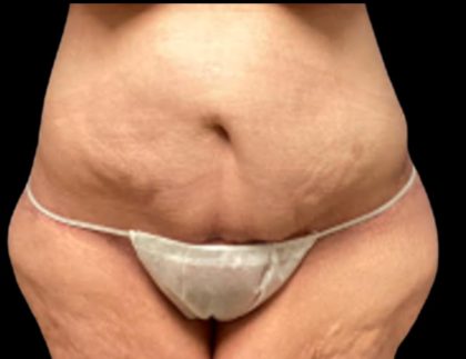 Liposuction Before & After Patient #6001