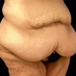 Liposuction Before & After Patient #6001