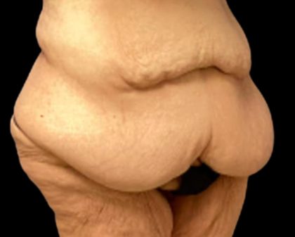 Liposuction Before & After Patient #6001