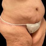 Liposuction Before & After Patient #6001