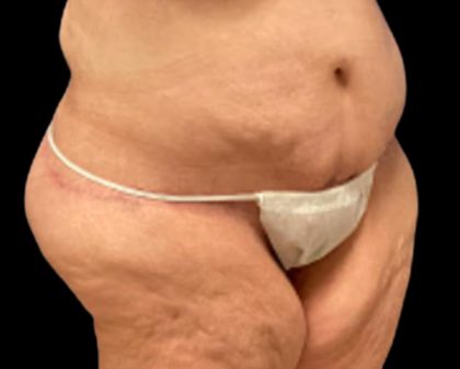 Liposuction Before & After Patient #6001