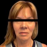 Facelift Before & After Patient #6090