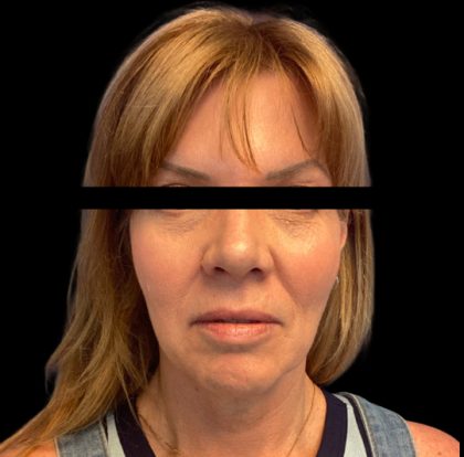 Facelift Before & After Patient #6090