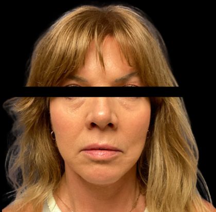 Facelift Before & After Patient #6090