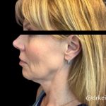 Facelift Before & After Patient #6090