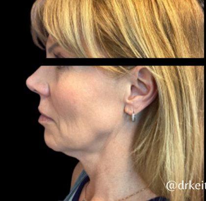 Facelift Before & After Patient #6090