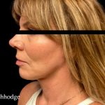 Facelift Before & After Patient #6090