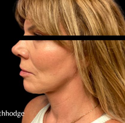 Facelift Before & After Patient #6090