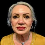 Facelift Before & After Patient #6091