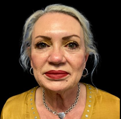 Facelift Before & After Patient #6091