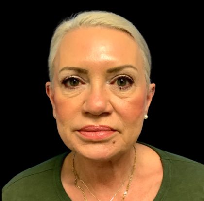 Facelift Before & After Patient #6091