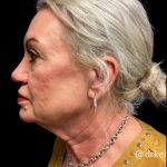 Facelift Before & After Patient #6091