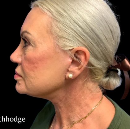 Facelift Before & After Patient #6091