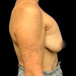 Implant Removal Before & After Patient #6019
