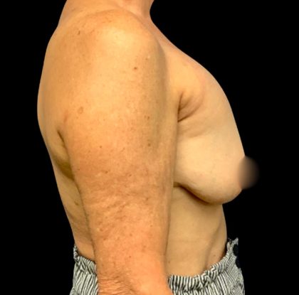 Implant Removal Before & After Patient #6019