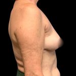 Implant Removal Before & After Patient #6019