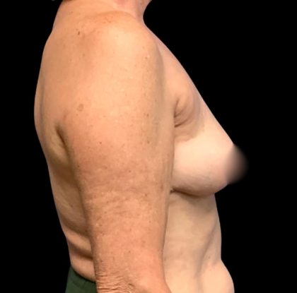 Implant Removal Before & After Patient #6019