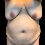 Mommy Makeover Before & After Patient #6021