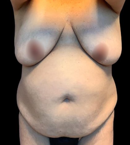 Mommy Makeover Before & After Patient #6021