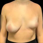 Breast Augmentation Before & After Patient #6023