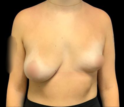 Breast Augmentation Before & After Patient #6023
