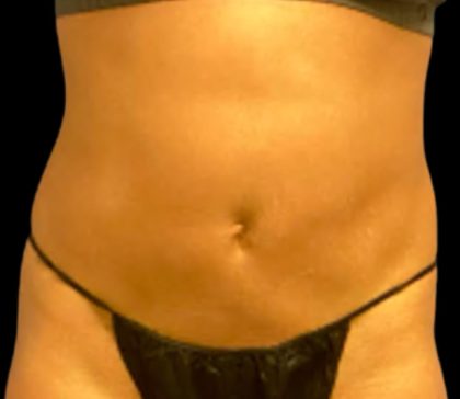 Vaser Liposuction Before & After Patient #6027
