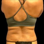 Vaser Liposuction Before & After Patient #6027