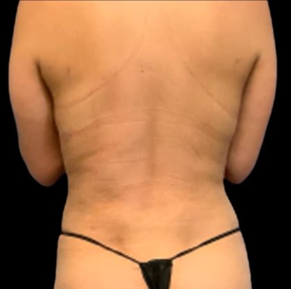 Vaser Liposuction Before & After Patient #6027