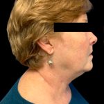Facelift Before & After Patient #6092
