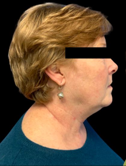 Facelift Before & After Patient #6092