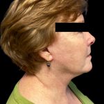 Facelift Before & After Patient #6092